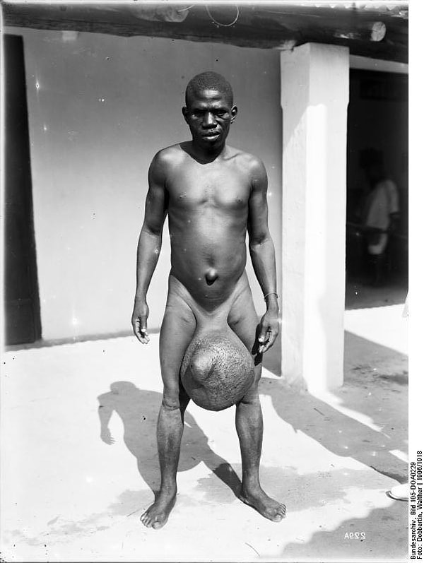 8. Чаще всего элефантиаз поражает ноги и мужские половые органы.