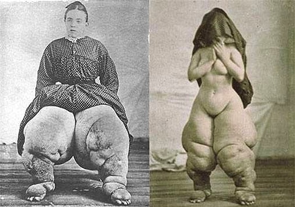 10. Использование антибиотиков, активным веществом которых является доксициклин, приводит к гибели бактерий, в симбиозе с которым живет червь, что в итоге приводит к его исчезновению.