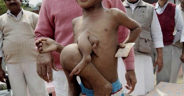 Deepak'ın vücudundan parazit olarak kalan ikizinin kolları ve bacakları var ancak başı yok.