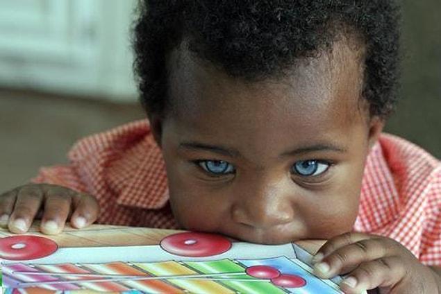 1. It can be said that Waardenburg Syndrome is vary rare. Only 1 out of 40,000 people have it