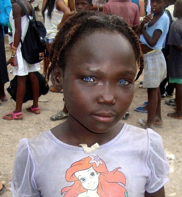 2. This Haitian girl's blue eyes are a miracle!