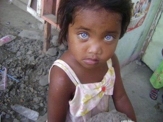 12. However, neither of the parents have to be blue-eyed for this syndrome to occur.