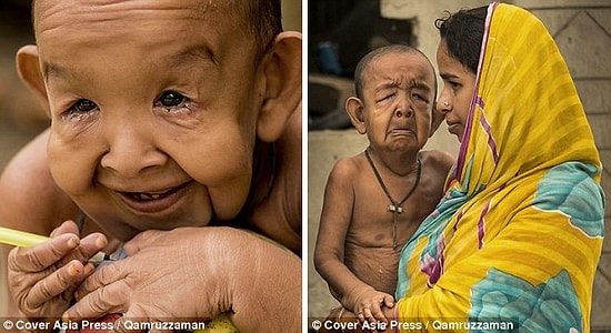 Hastalığı Nedeniyle 80 Yaşında Gibi Gözüken 4 Yaşındaki Bangladeşli Çocuk