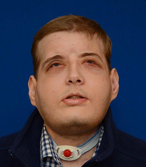 Patrick Hardison'ın yüzü, ameliyattan 6 ay sonra bu şekilde görünmeye başlar.