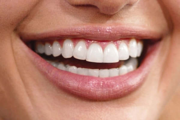 4. Öpüşmek, diş çürümesine sebep olabilmektedir.
