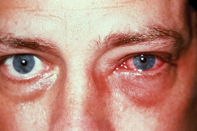 1. Adenoviral Hastalıklar
