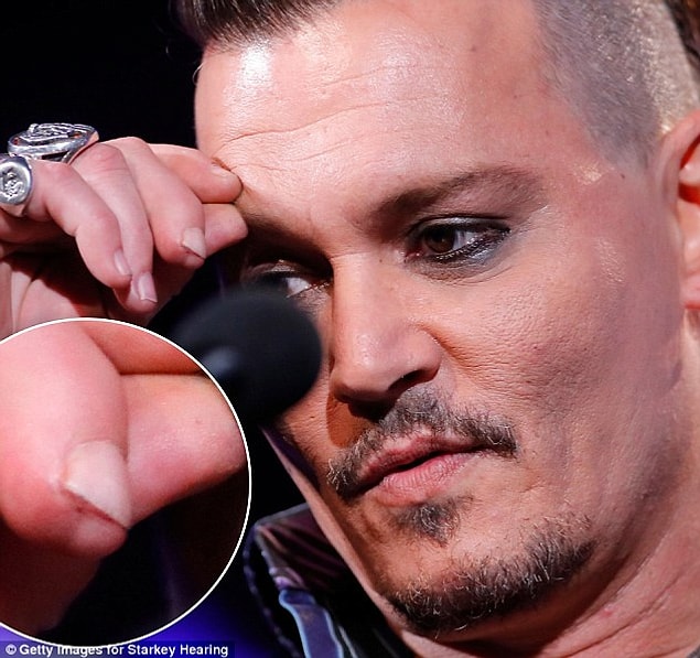 Yine Heard'ün iddialarına göre Depp 22 saat içinde tedavi olmadı, bu nedenle de doktorlar elinden kesilen bir parçayı parmağının ucuna yamamak zorunda kaldı.