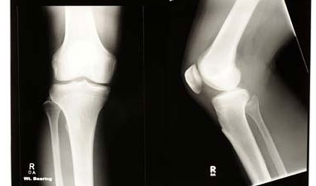 4. We are born without kneecaps. Kneecaps develop when we are 2-6 years old.