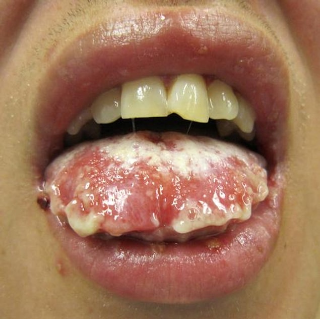 11. Stevens-Johnson Sydrome (Toxic Epidermal Necrolysis)