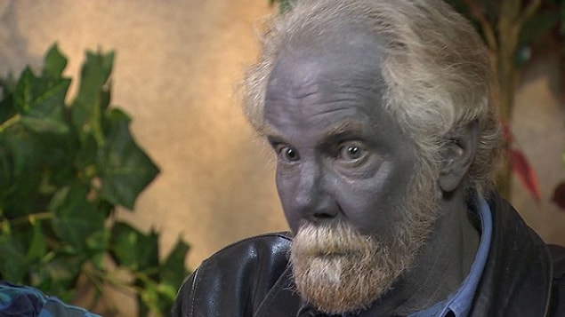 13. Argyria