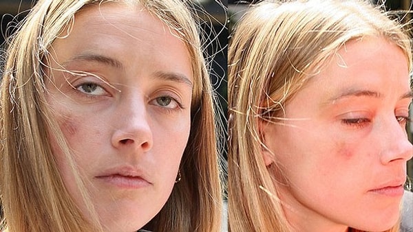 4. Девушка обратилась в суд, продемонстрировав журналистам свои синяки и ссадины.