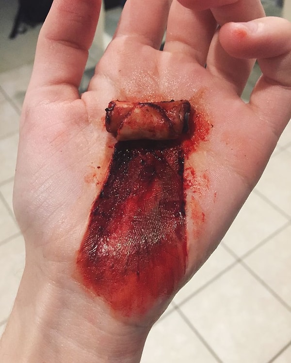 5. Содранная кожа