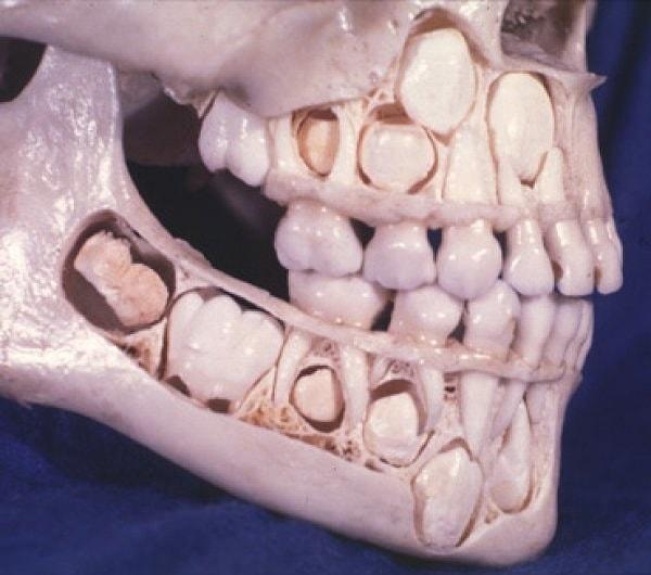 11. Bir gün merak ederseniz diye, bu da süt dişleri hala ağzında olan insan kafatasının fotoğrafı.