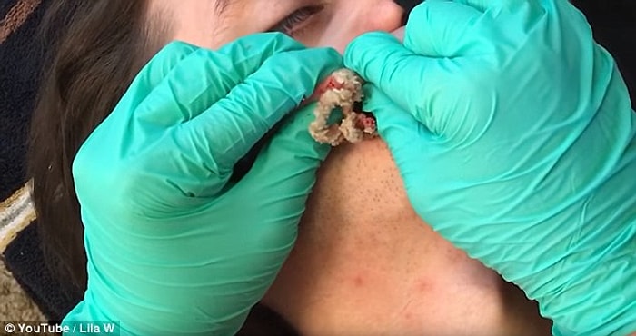 Erkek Arkadaşının Suratındaki Kisti Sıkarak İçinden Dünyaları Çıkartan Kadın