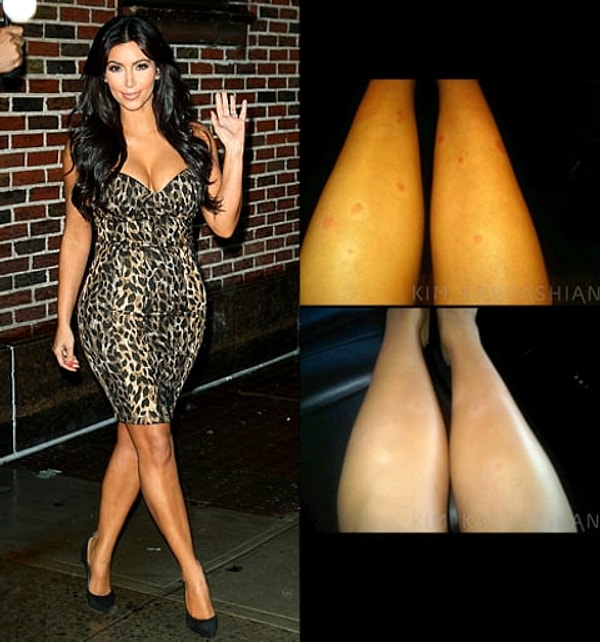 У страдающих этим недугом большая часть тела покрывается красными пятнами, а сама кожа сильно шелушится.