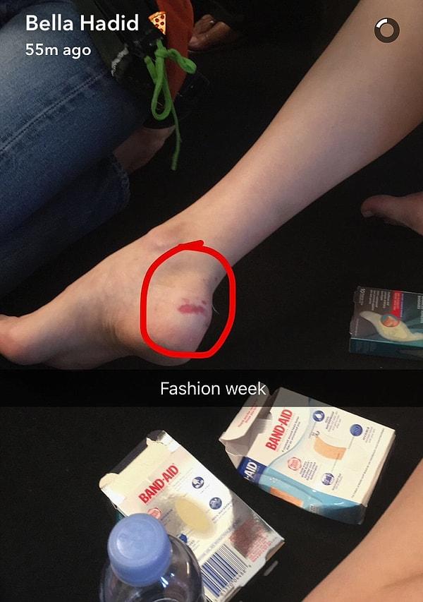 Bella sonrasında Snapchat'ten yaralı ayağını paylaşarak, modelliğin aslında göründüğü kadar kolay olmadığını herkese gösterdi.