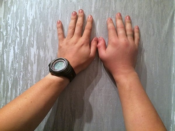 "Травмпункт поликлиники в Москве ~ 4 часа после укуса. Рука синеет потихоньку. Из травмпункта вызвали скорую, которая увезла в Токсикологическое отделение Склифа. По пути прокапали одну капельницу"