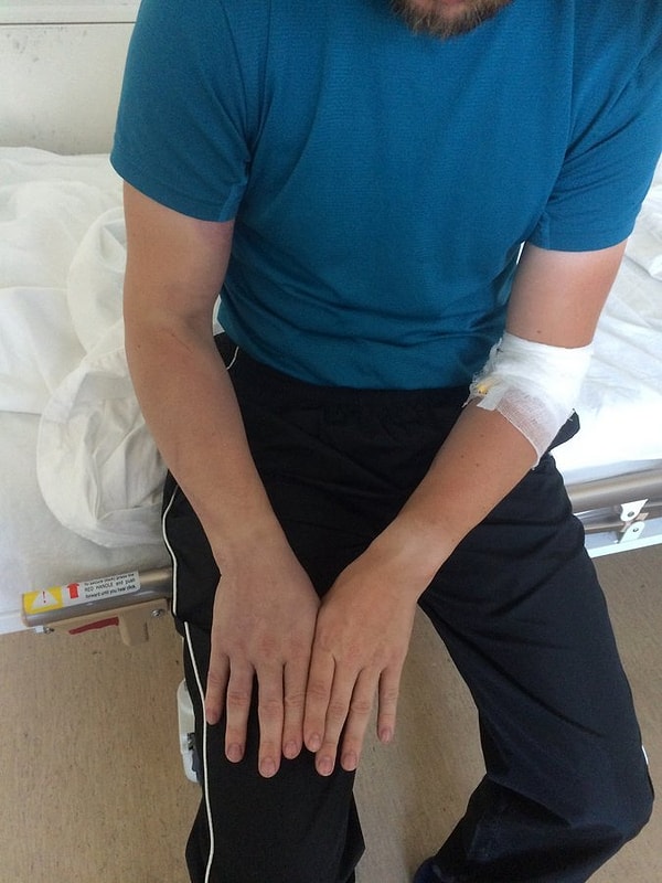 "Сразу вкатили еще 3 капельницы, антибиотики, и, видимо, сыворотку. К утру опухоль начала спадать, оставляя на своем месте синяки вдоль вен и в местах, где побольше мышц"