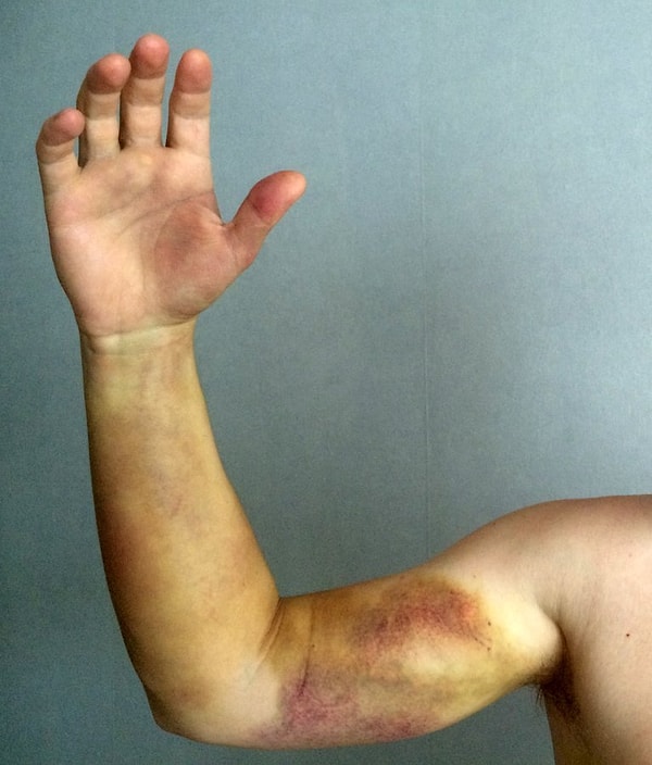 "Дома лечение было прописано следующее: Лиатон мазь – на всю руку по возможности (я мазал перед сном), Аспирин асс – по инструкции"