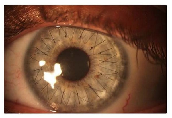 9. Пересадка роговицы