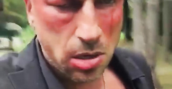 Нагиев шокировал пользователей Instagram разбитым лицом