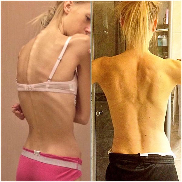 Ей очень повезло. Казандра смогла вернуться к нормальной жизни, а многие другие не успевают этого сделать.