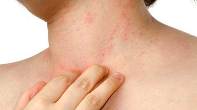 4. İnsanların çoğunda alerji olarak da etki gösterebilen bu maddeler, kişinin başka maddelere olan alerjisini de tetikleyebiliyor.
