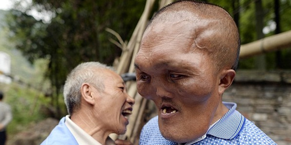 Yüzündeki Deformelerden Ötürü Sağır Olan ve Hayatını Değiştirecek Ameliyatı Bekleyen Adam