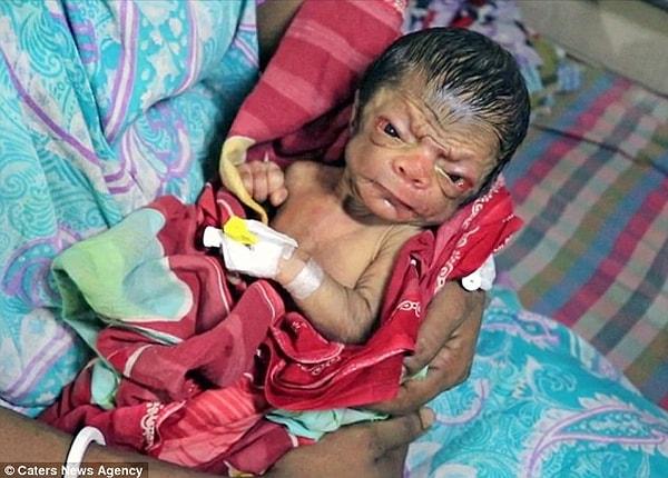 Bangladeş'te dünyaya gelen bebek sırtındaki tüylü kısım, çukurlu gözleri, pürüzlü derisi ve kırışıklıklarıyla yeni doğan bir bebekten ziyade, 80 yaşında birine benziyor.