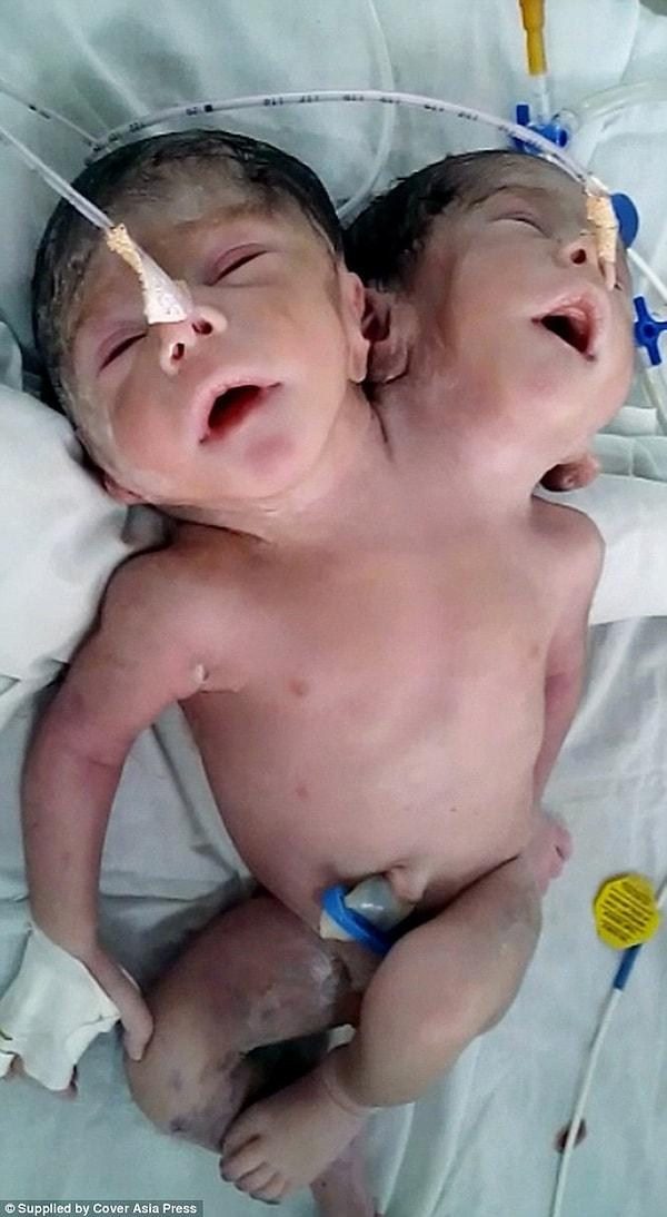 "İki başlı bir bebek dün sağlıklı bir şekilde dünyaya geldi."
