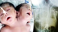 Hindistan'da Doğumundan 32 Saat Sonra Hayatını Kaybeden İki Başlı Mucize Bebek