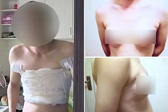 Çin'de İş Bulamayan Adam İş Bulmak İçin Memelerine Silikon Taktırdı