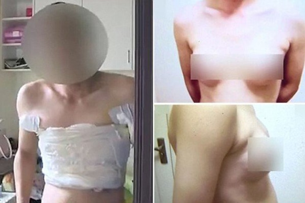 Çin'de İş Bulamayan Adam İş Bulmak İçin Memelerine Silikon Taktırdı