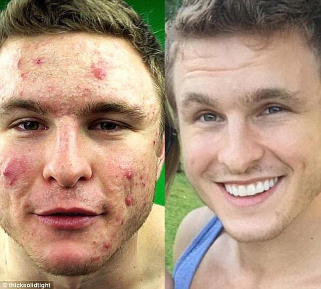 So after trying different other remedies, tips and treatments, he decided to go vegan and it worked!