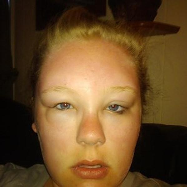 30. Florida'ya gidip güneş alerjisi geliştiren bu kızın olayı 7 gün sürmüş.