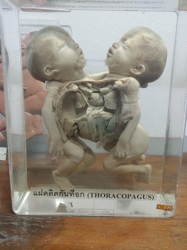 5. Doğumdan hemen sonra ölmüş ikiz bebekler