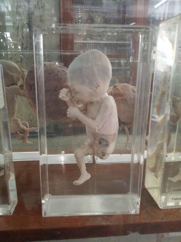 8. Minik bir fetus