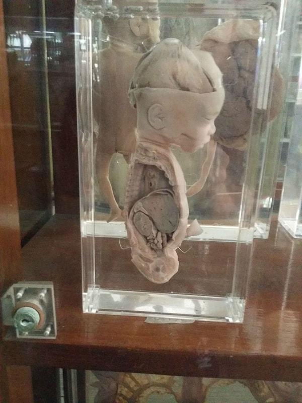 12. 6 aylıkken ölmüş bir bebek