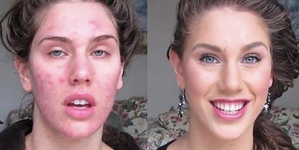 Sivilce Belasından İllallah Edenlere Çare Olacak 16 Doğal Yöntem