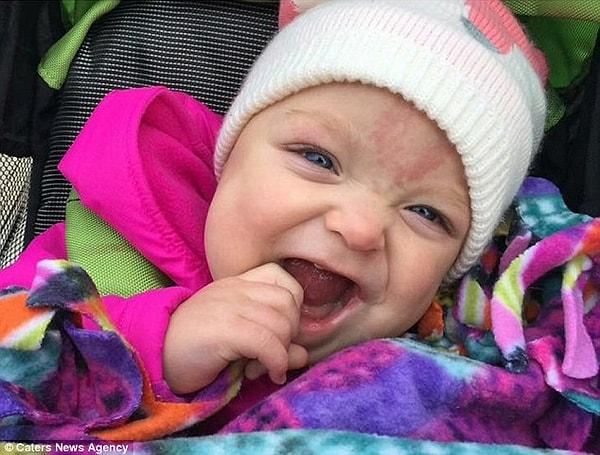 Biz de doktorları ve ailesi gibi bu güzel bebeğin yeni bir operasyona ihtiyaç duymamasını umuyor, gülücüklerinin hiç eksilmemesini diliyoruz.🙏