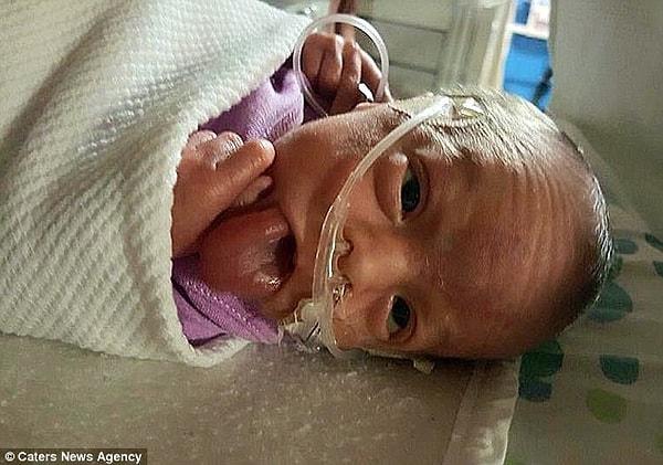 13.700 insanda bir görülen bu hastalığa yakalanan sevimli bebek hayatının ilk haftasını oksijen desteği alarak geçirdi.