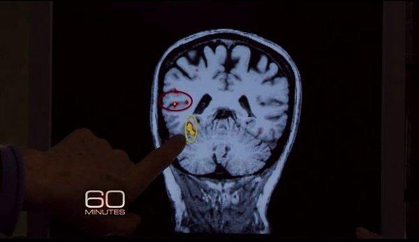 Beynimizin, yüzleri tanırken kullandığımız bölgesine bilim insanları "fusiform yüz alanı" ismini vermektedir.
