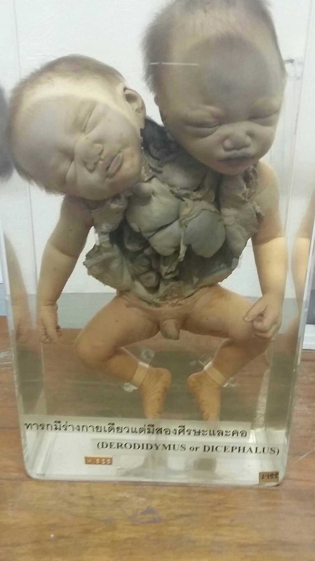 10. A double-headed baby torso