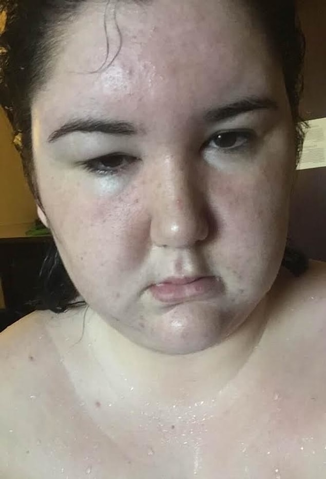 6. She tried to dye her hair on New Year's and found out she was allergic to acids...in apple...which were also found in some hair dyes.