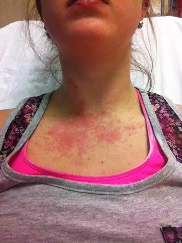 12. Hospitalized because of her nickel necklace!