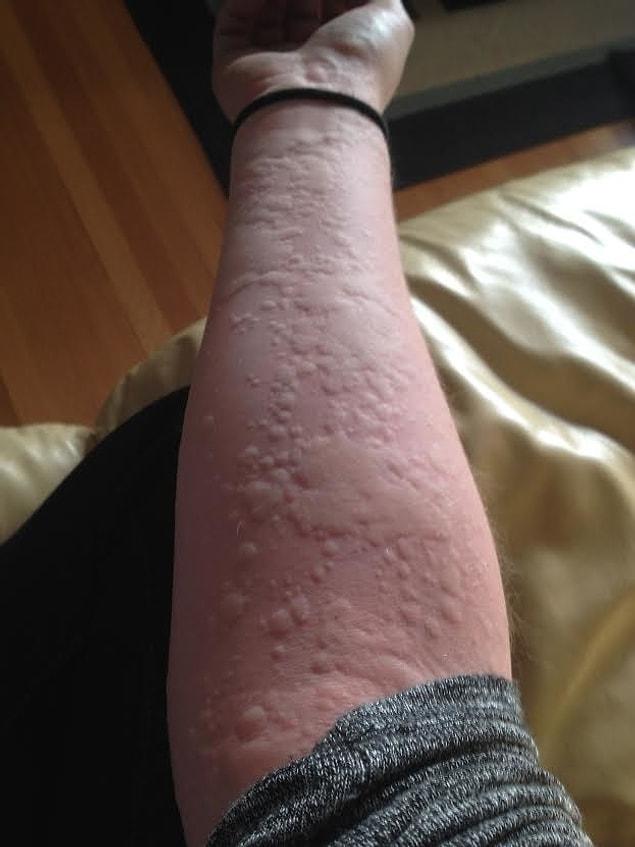 13. This person's arm that looks like the world map made out of rash.