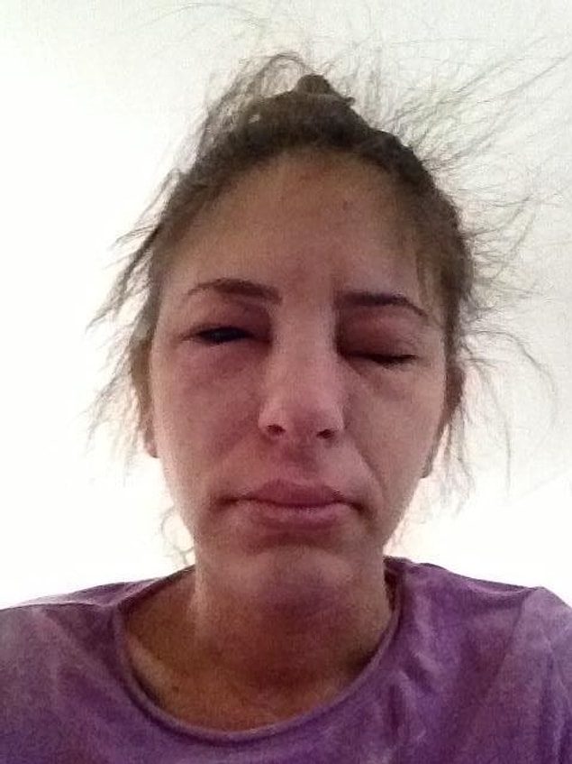 14. The woman who petted her dog and learned it had gone through poison oak!