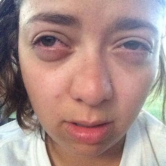 19. Well some people are lucky enough to get these faces every year from seasonal allergies.