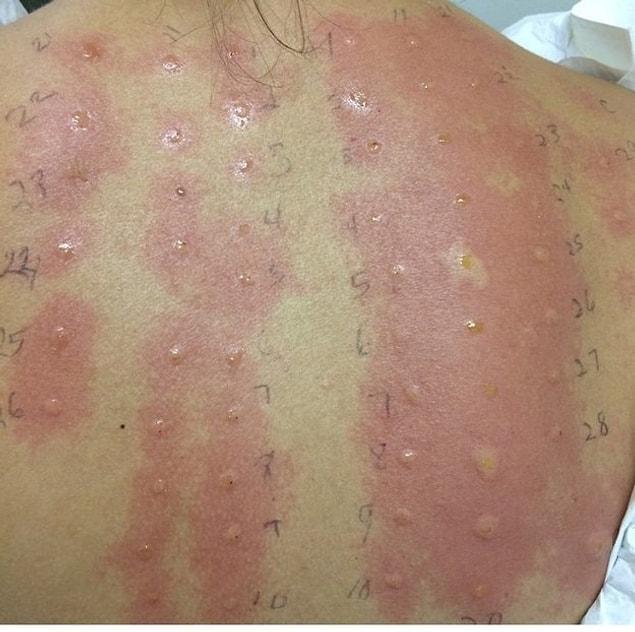 31. Have you ever tried getting tested for allergies? It turns out you can be allergic to "life" like this woman is.