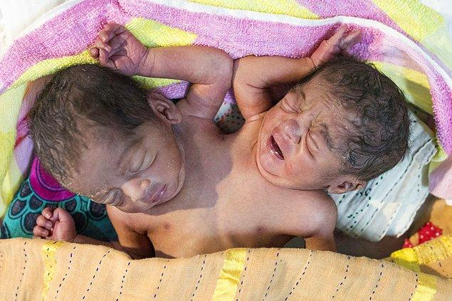 2. 15 Ekim günü Bangladeş'te bir hastaneye terk edildikleri iddia edilen yapışık ikizler.